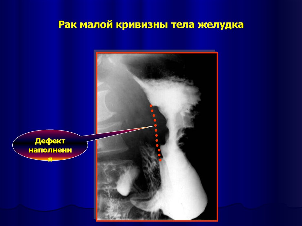 Кривизна желудка. Дефект наполнения желудка. Малой кривизны желудка. Опухоль малой кривизны желудка. Дефект наполнения по малой кривизне.