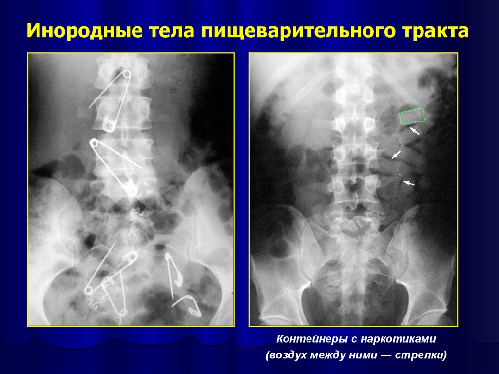 Предметы в органах. Инородные тела пищеварительного тракта. Инородные тела желудочно-кишечного тракта. Рентгенодиагностика инородных тел. Инородное тело в кишечнике.