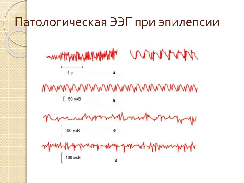 Ээг показывает эпилепсию. ЭЭГ энцефалограмма эпилепсия. ЭЭГ волны эпиактивность. ЭЭГ здорового человека и эпилептика. Электроэнцефалография, норма, ЭЭГ, видеомониторинг ЭЭГ при эпилепсии\.