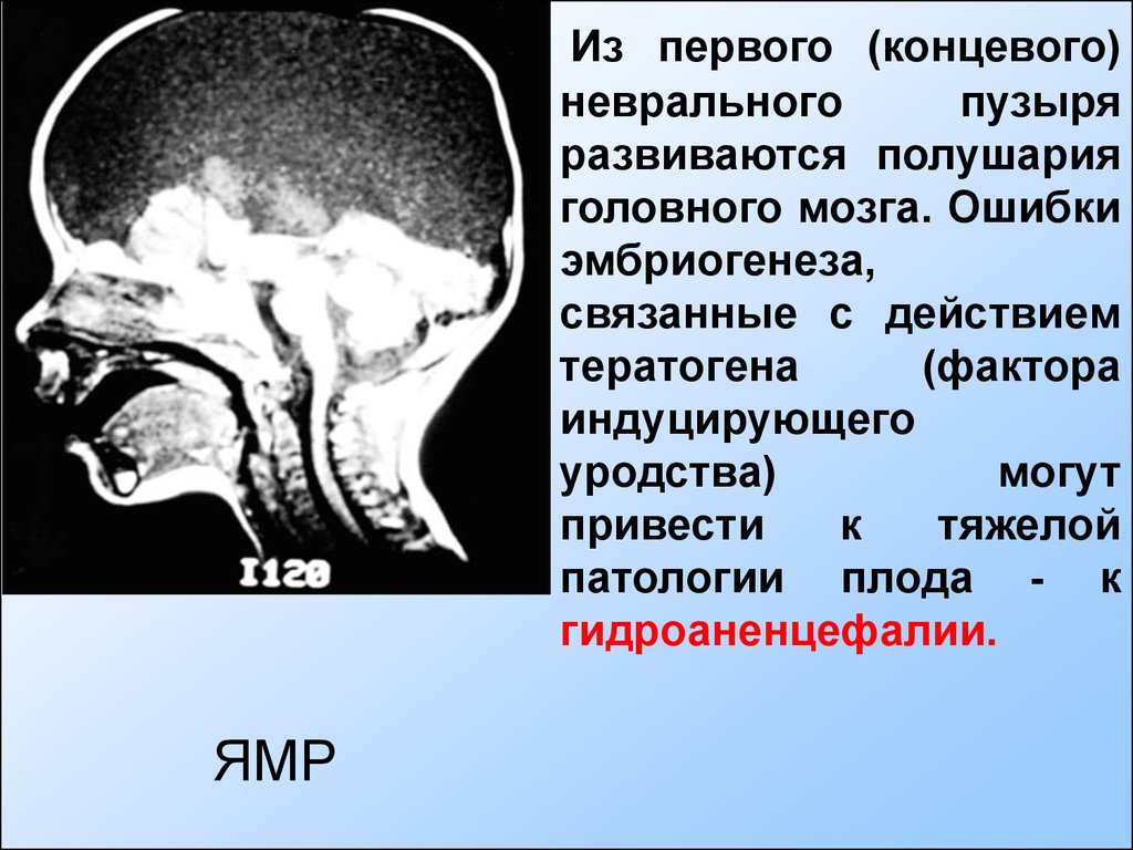 Анатомо-физиологические особенности полушарий головного мозга. Невральный путь. Высокое небо при действии тератогенов.
