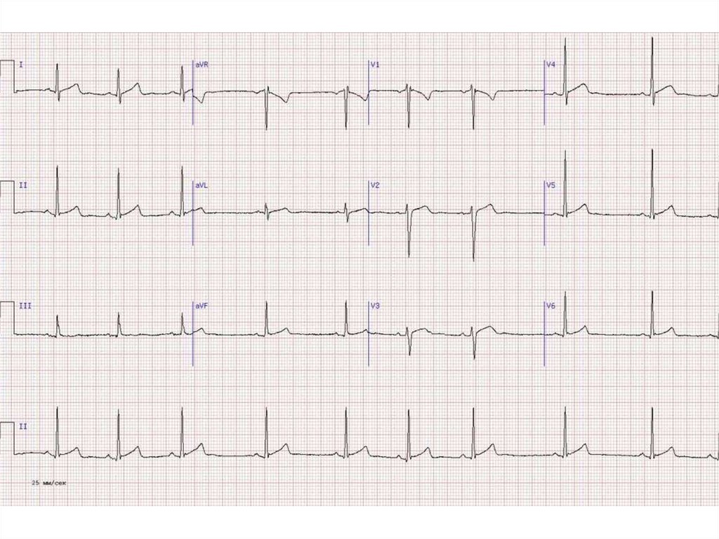 Тяжелое экг. ЭКГ норма. Кардиограмма сердца норма. ЭКГ сердца норма снимок. ЭКГ вариант нормы.