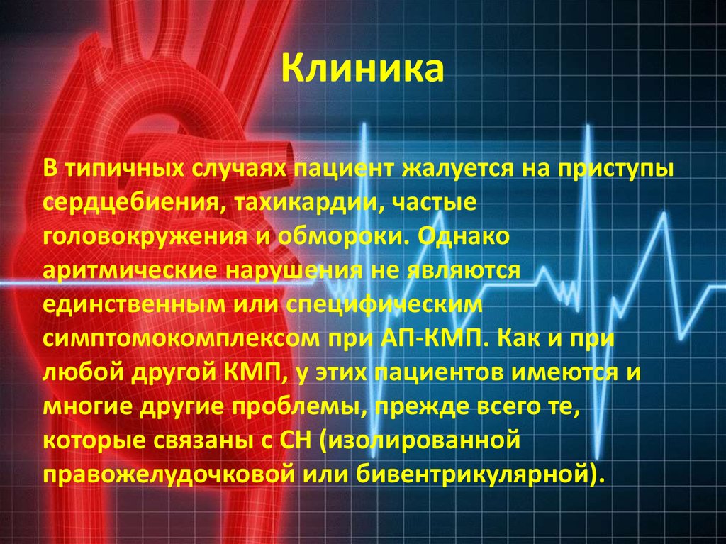 Головокружение частый пульс. Приступы сердцебиения. Аритмическая форма ИБС. Аритмическая КМП.