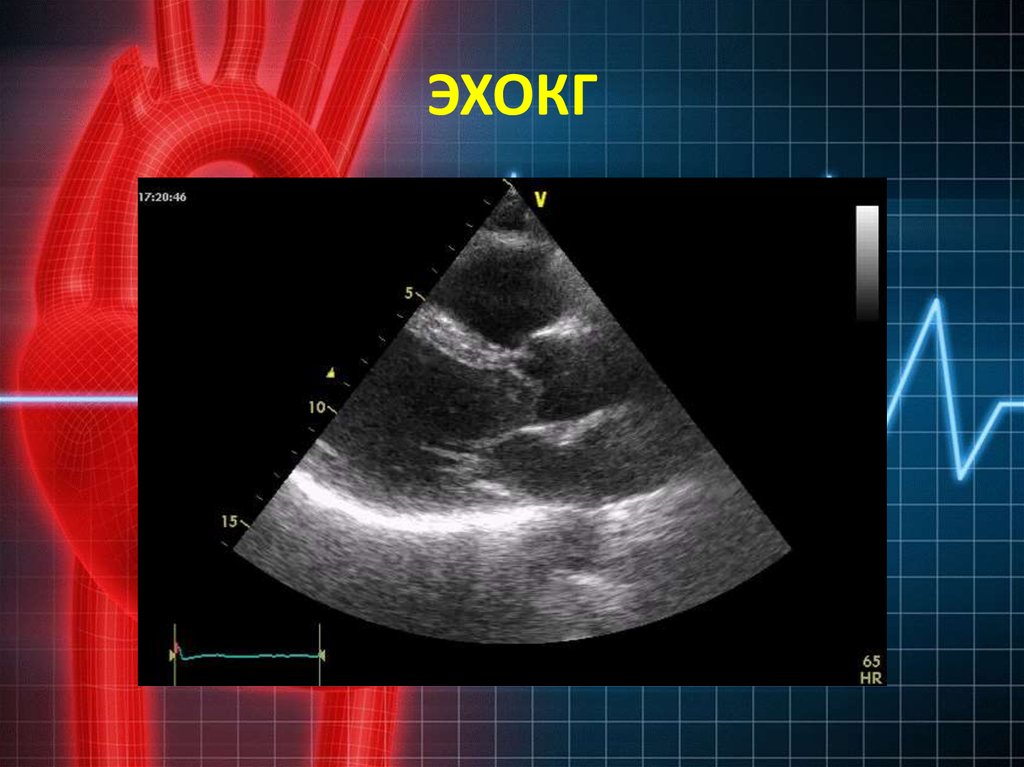 Эхокардиография сердца фото