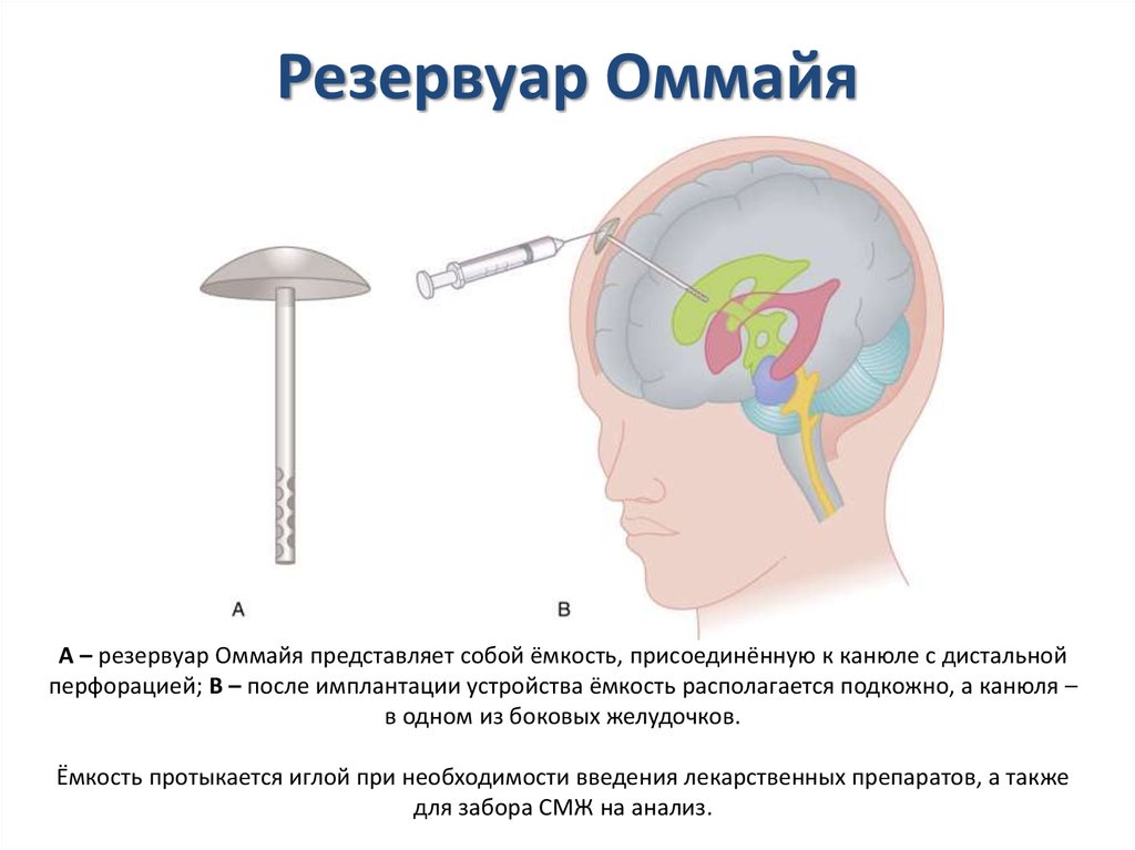 Шунт головного мозга. Подкожный вентрикулярный резервуар Ommaya.. Резервуар Омайя и Введение химиотерапии в желудочки мозга. Шунт для отвода ликвора. Шунт головного мозга при гидроцефалии.