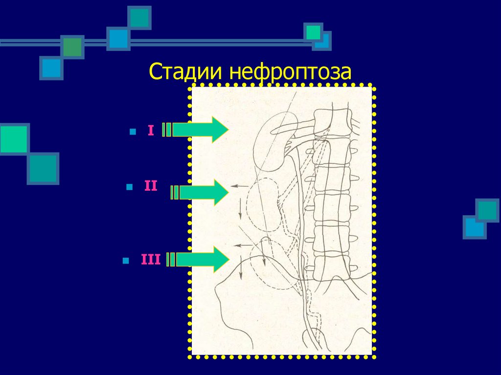 Нефроптоз степени. Нефроптоз классификация. Степени нефроптоза рентгенологически. Нефроптоз рентген степени.