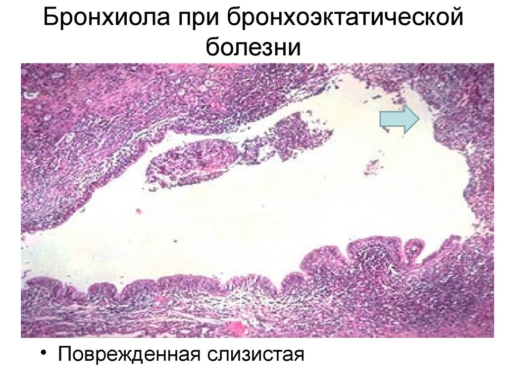 Хр бронхит карта вызова