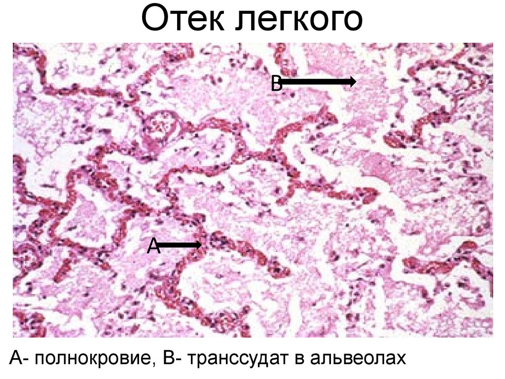 Отек легких таблетки. Отек легкого препарат патанатомия. Отек легкого гистология. Отек лёгких микропрепарат. Интерстициальный отек легкого микропрепарат.