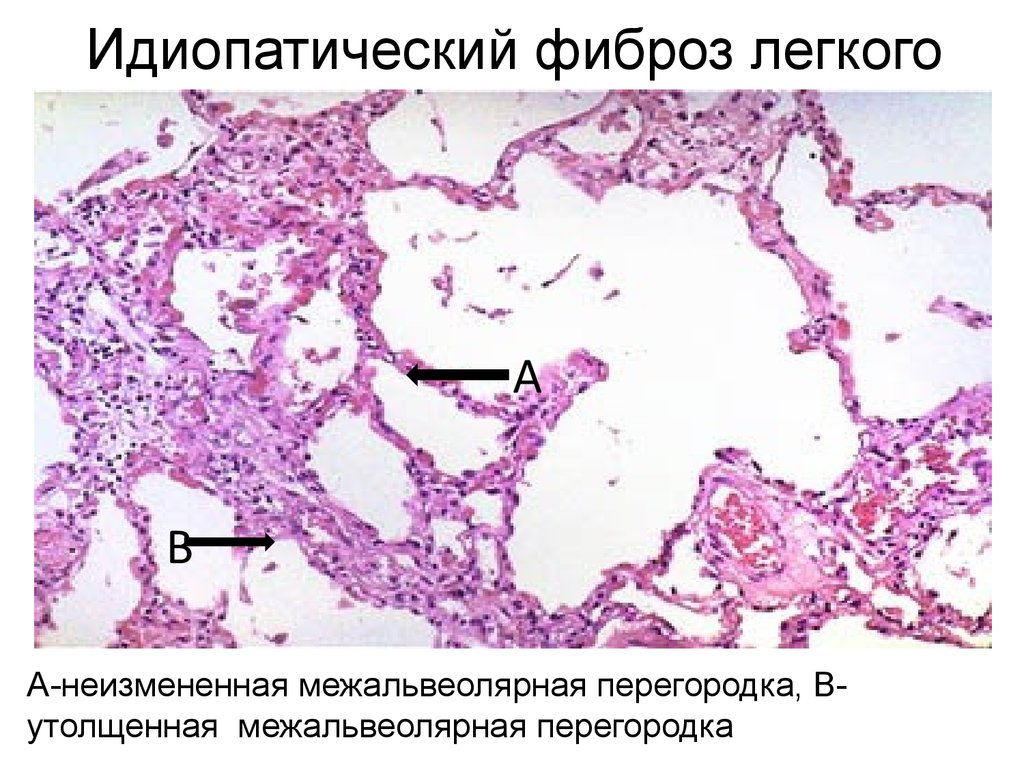 Картина фиброзных изменений. Межальвеолярные перегородки гистология. Идиопатический легочный фиброз гистология. Фиброз легкого гистология. Идиопатический фиброзирующий альвеолит.