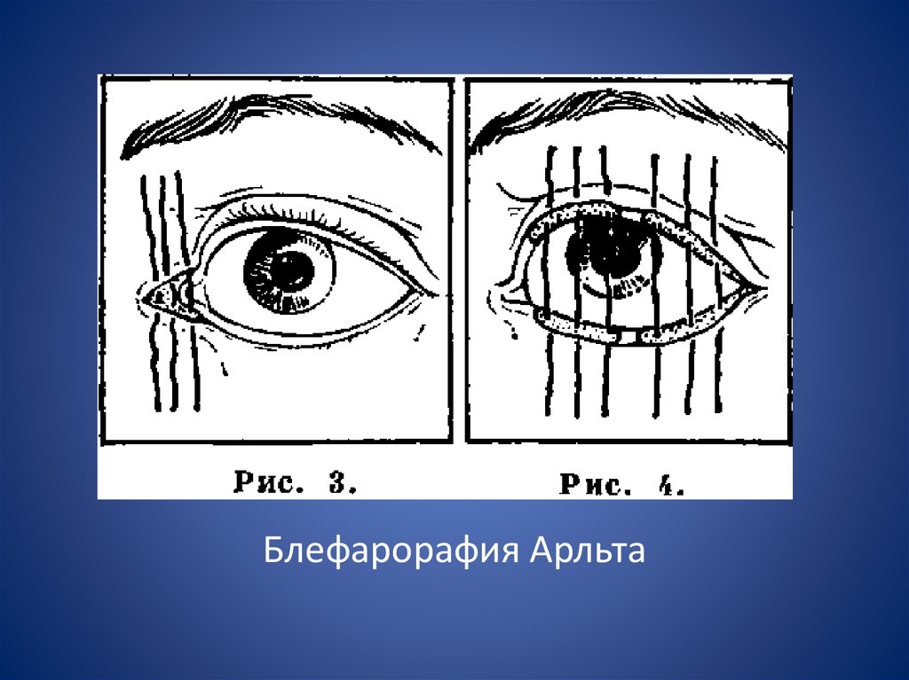 Для клинической картины лагофтальма характерно все кроме