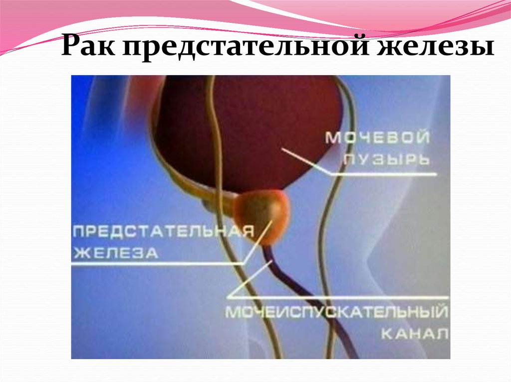 Код мкб аденома простаты. Опухоль предстательной железы. Мочевой пузырь и предстательная железа. Онкология предстательной железы. Новообразование предстательной железы мкб.