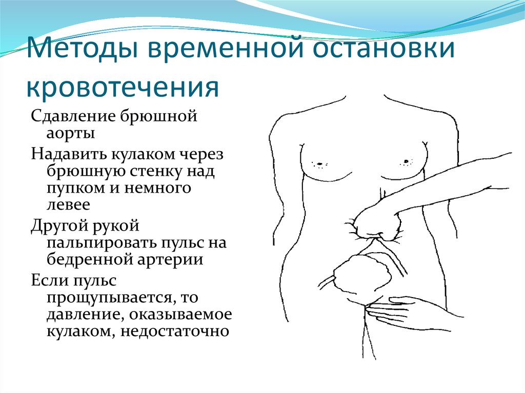 Методы временной остановки кровотечения