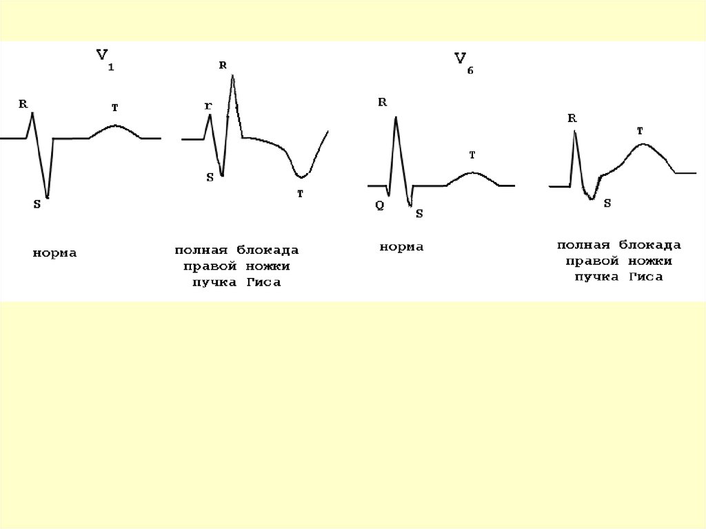 Полная блокада ножки. Полная блокада правой ножки пучка Гиса. Полная блокада правой ножки Гиса на ЭКГ. Блокада ПНПГ на ЭКГ. ЭКГ при полной блокаде ножек пучка Гиса.