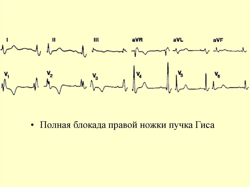 Полная блокада правой ножки гиса