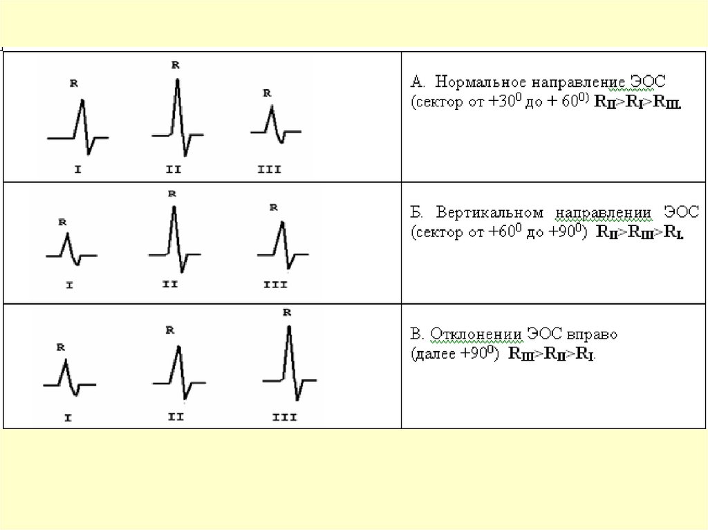 Что значит вертикальная ось. Электрическая ось сердца на ЭКГ как определить. ЭКГ при изменении направления электрической оси сердца. Эл ось сердца норма ЭКГ. Отклонение электрической оси сердца на ЭКГ как определить.