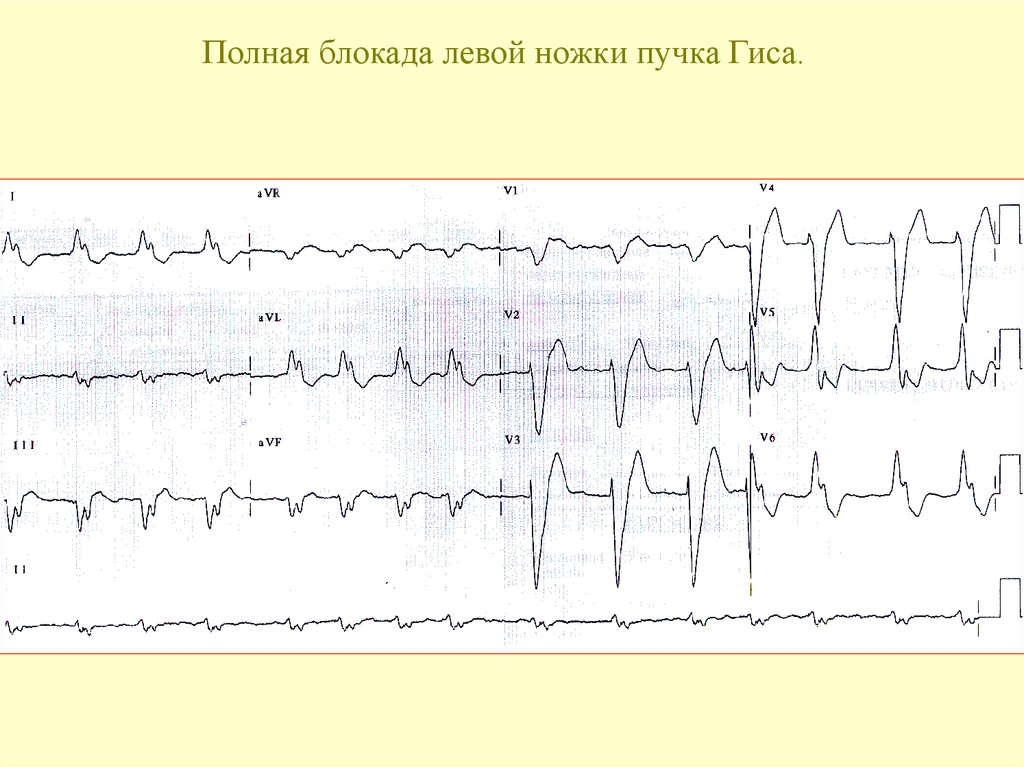 Блокада левой ножки пучка гиса экг. ЭКГ приблокадах ножек пучка Гисса. Полная блокада левой ножки пучка Гиса на ЭКГ. Полная блокада ЛНПГ на ЭКГ. Блокада задней ветви ЛНПГ на ЭКГ.