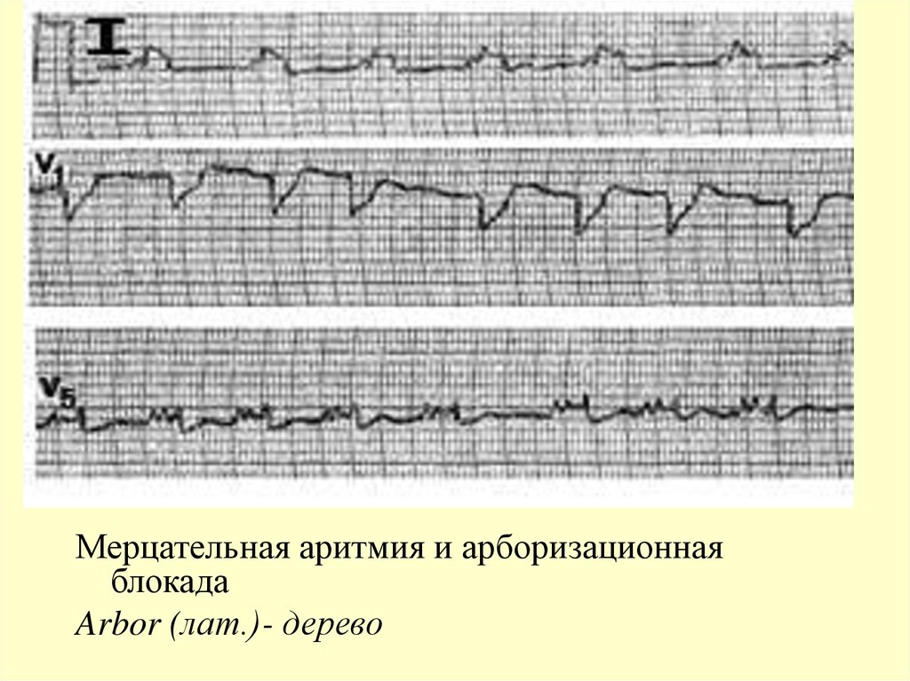 Мерцательная аритмия это. Арборизационная блокада на ЭКГ. Мерцательная аритмия с АВ блокадой. Мерцательная аритмия и ножки Гиса блокада. ЭКГ аритмии и блокады.