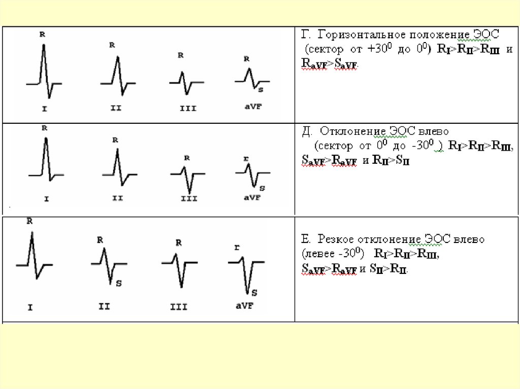 Эос экг что значит. ЭКГ отклонение электрической оси влево что это. Отклонение электрической оси сердца на ЭКГ. Смещение электрической оси сердца на ЭКГ. Ось сердца на ЭКГ отклонена.