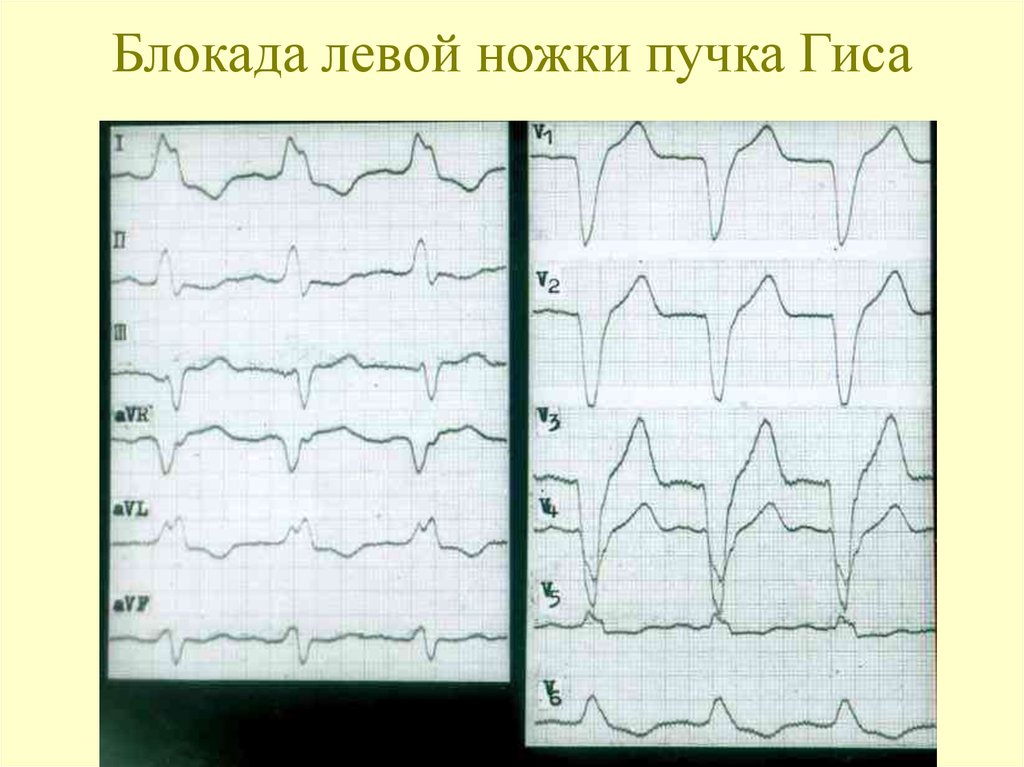 Блокада левого пучка гиса экг. Неполная блокада левой ножки пучка Гиса на ЭКГ. Неполная блокада ЛНПГ на ЭКГ. Неполная блокада левой ножки на ЭКГ. Не полная блокада левой ножки пучка Гиса.