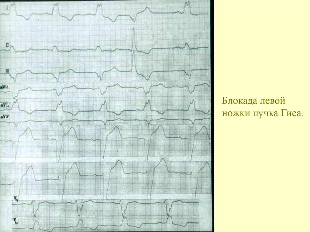 Блокада левой. Интермиттирующая блокада левой ножки. Интермиттирующая блокада левой ножки пучка Гиса. Полная блокада левой ножки пучка Гиса на ЭКГ. Блокада ЛНПГ.