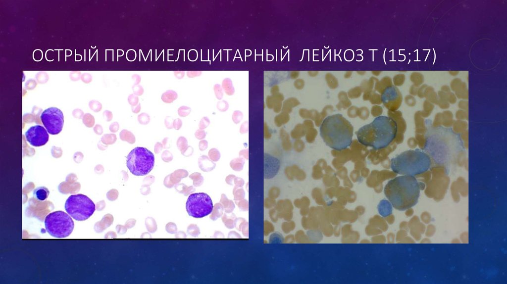 Лейкоз код. Острый промиелоцитарный лейкоз презентация. Острый промиелоцитарный лейкоз картина крови. Острого промиелоцитарного лейкоза. Острый промиелоцитарный лейкоз классификация.