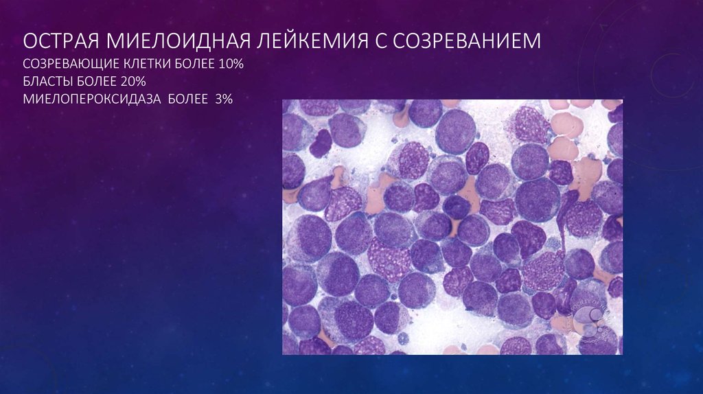 Острый миелоидный лейкоз тесты нмо. Острый миелобластный лейкоз. Острый монобластный лейкоз. Острый миелоидный лейкоз классификация. Острый миелоидный лейкоз с созреванием.