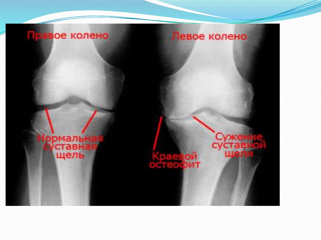 Сустав норма. Деформирующий артроз коленного сустава рентген. Деформирующий артроз коленного сустава рентген степени. Рентген стадии гонартроза. Доа тазобедренного сустава рентген.
