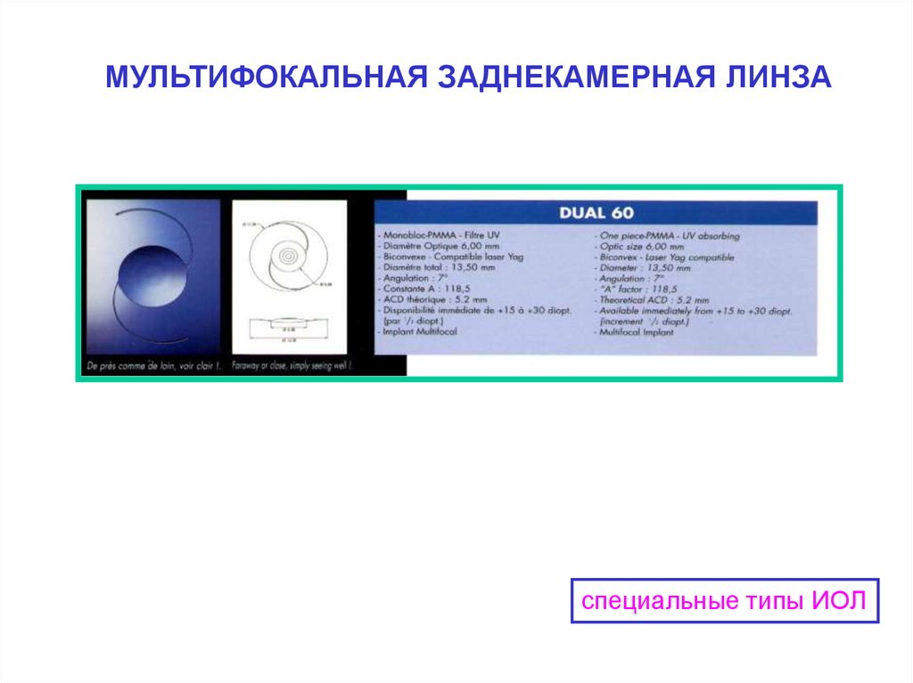 Мультифокальные линзы операция. Разметка для мультифокальных линз. Мультифокальный хрусталик. Мультифокальные кл конструкция.