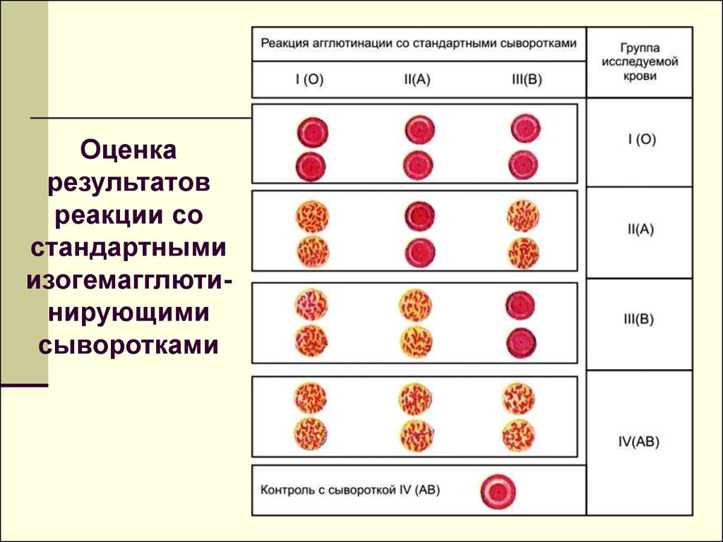 Группа крови перекрестный метод. Реакция агглютинации со стандартными сыворотками. Схема реакции агглютинации группы крови. Реакция агглютинации со стандартными сыворотками группа крови. Реакция агглютинации со стандартными сыворотками таблица.