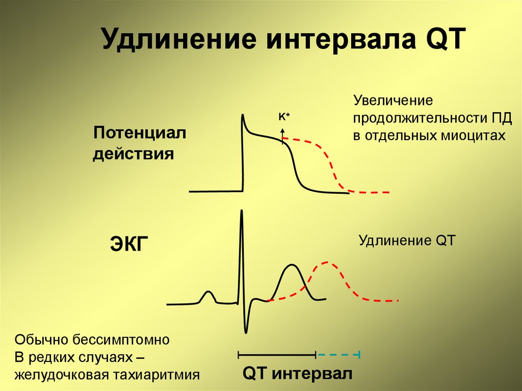 Удлиненное qt у ребенка. Синдром удлиненного интервала qt на ЭКГ. Удлиненный интервал qt на ЭКГ что это такое. Удлинённый интервал qt на ЭКГ. ЭКГ С синдромом удлиненного интервала qt у детей.