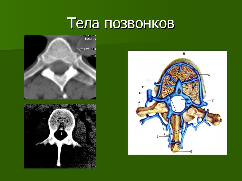 Тело позвоночника. Тело позвонка. Кт анатомия позвонка. Анатомия тела позвонка на кт. Мрт анатомия позвоночника.