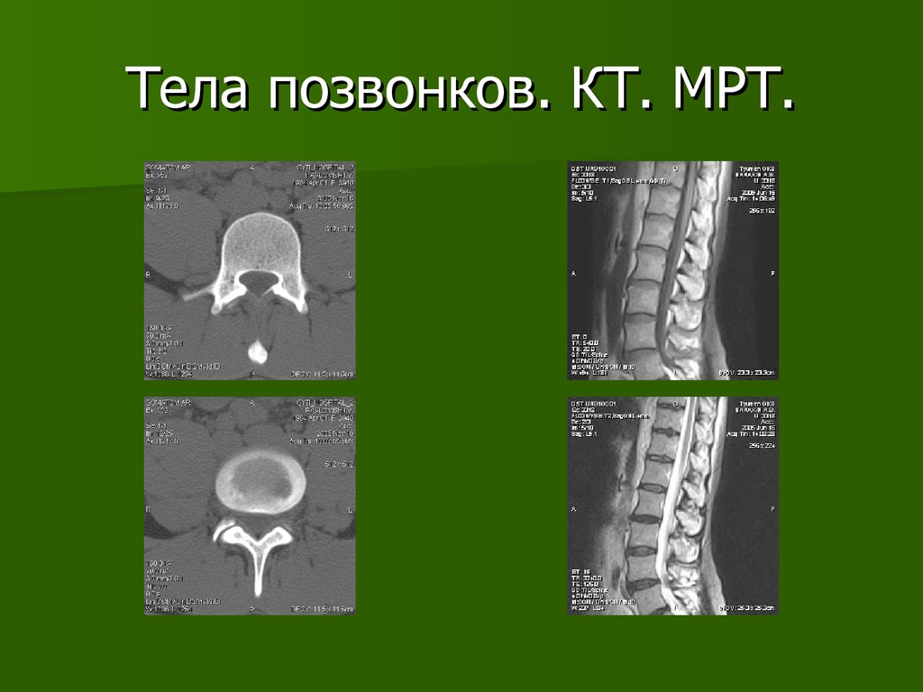 Форма тел позвонков