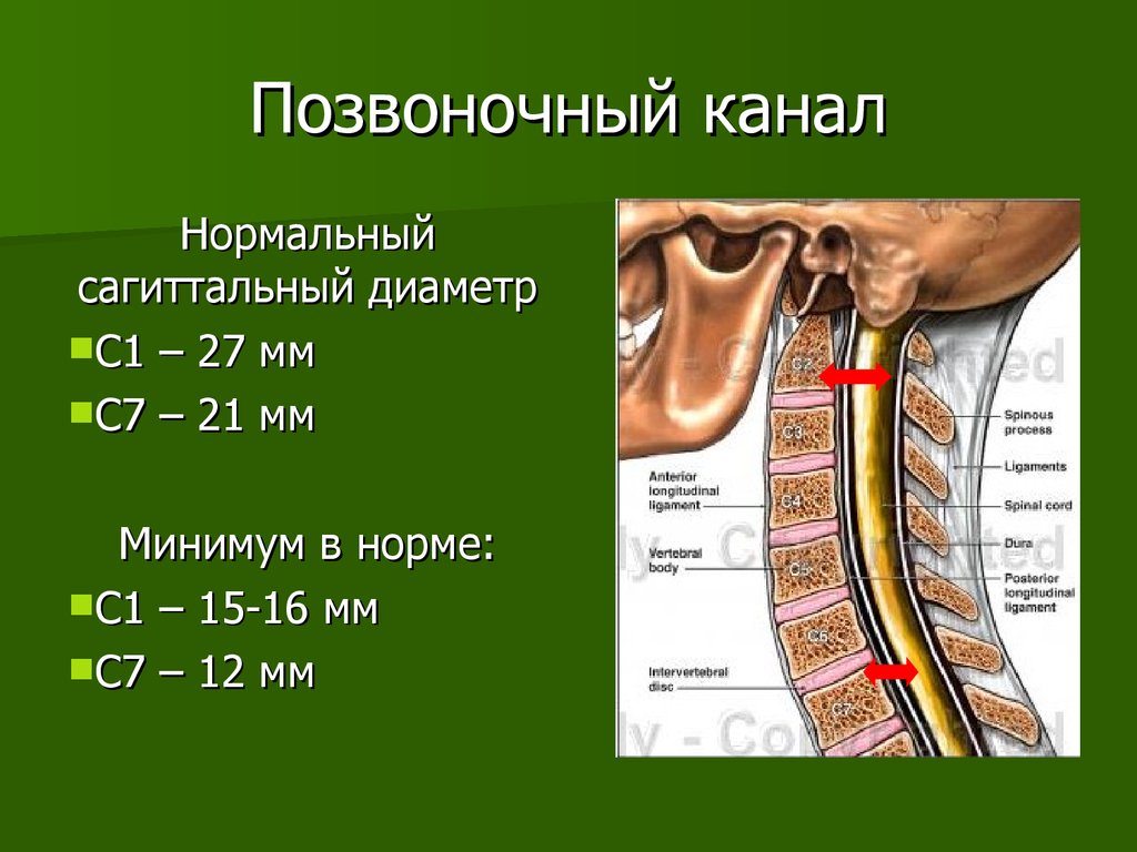 Позвоночный канал это. Ширина позвоночного канала в шейном отделе 13 мм. Сагиттальный размер позвоночного канала норма кт. Сагиттальный просвет позвоночного канала норма. Позвоночный канал сагиттальным размером норма.