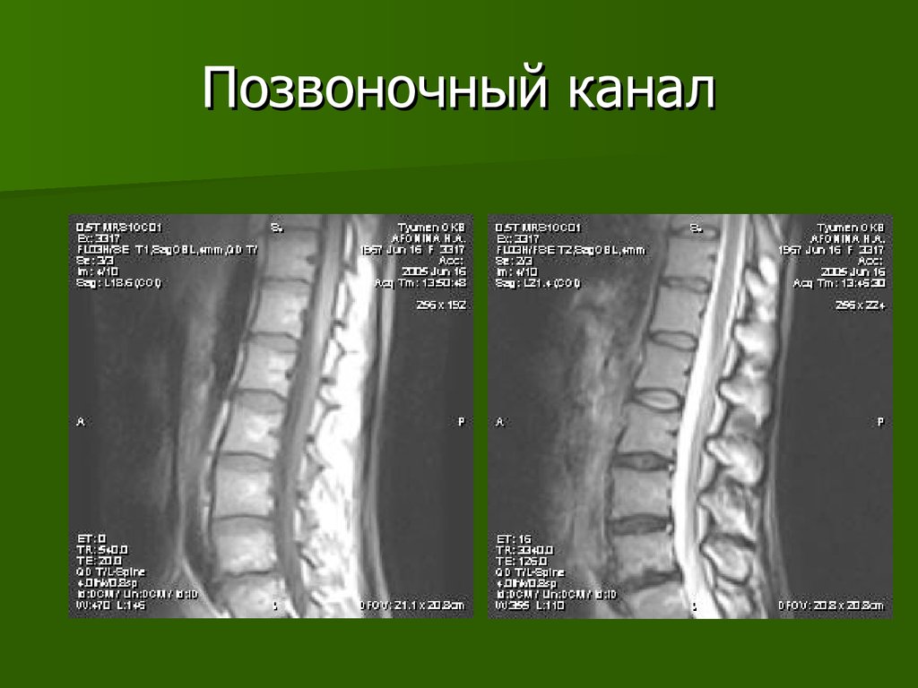 Позвоночный канал это