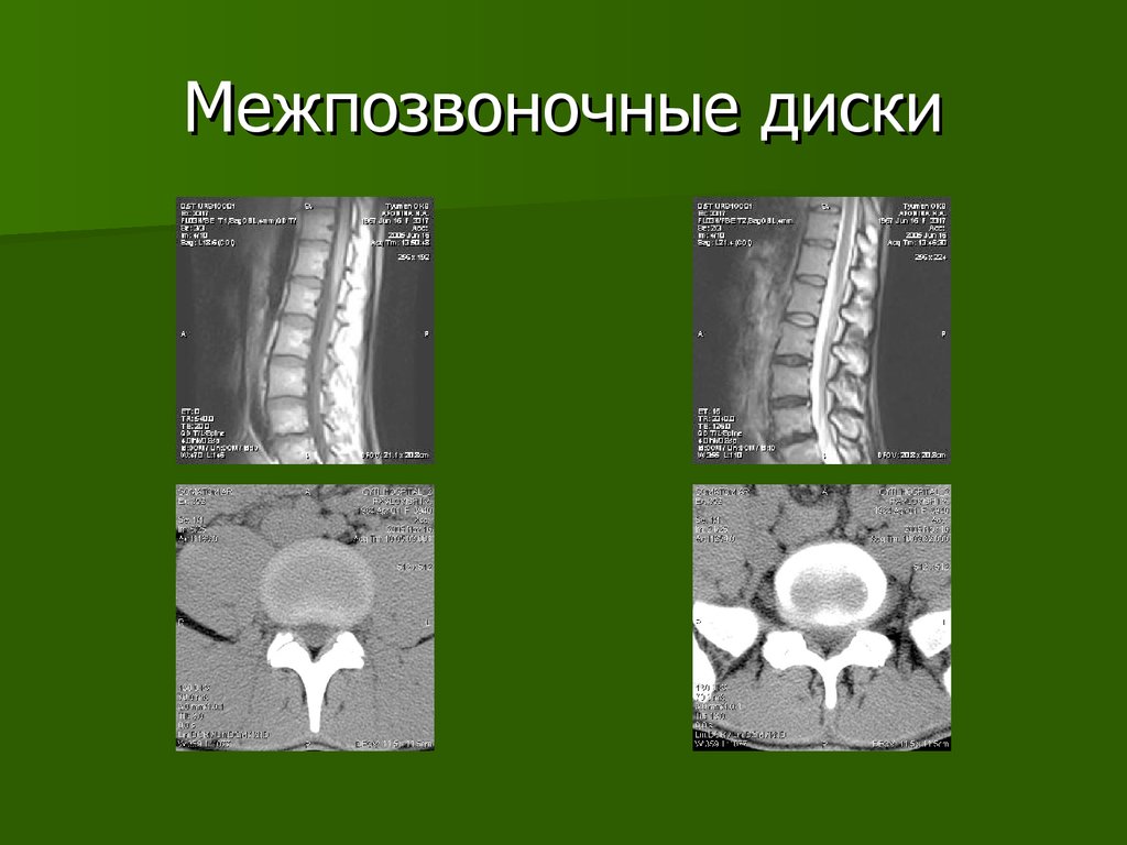 Высота межпозвоночного диска