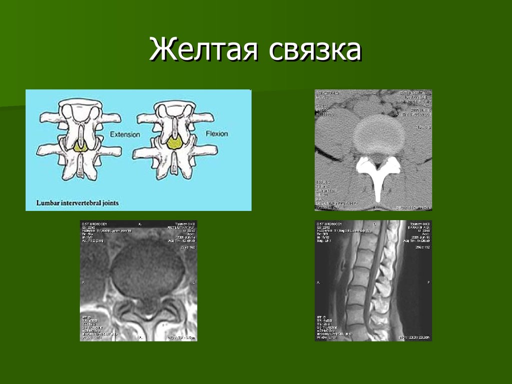 Желтые связки. Желтые связки позвоночника на кт. Гипертрофия желтых связок кт. Обызвествление желтых связок кт. Желтая связка анатомия мрт.