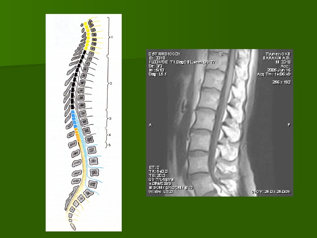 Отделы позвоночника для мрт. Кт анатомия позвоночника. Анатомия поясничного позвонка на кт. Мрт анатомия позвоночника. Отделы позвоночника для кт схема.
