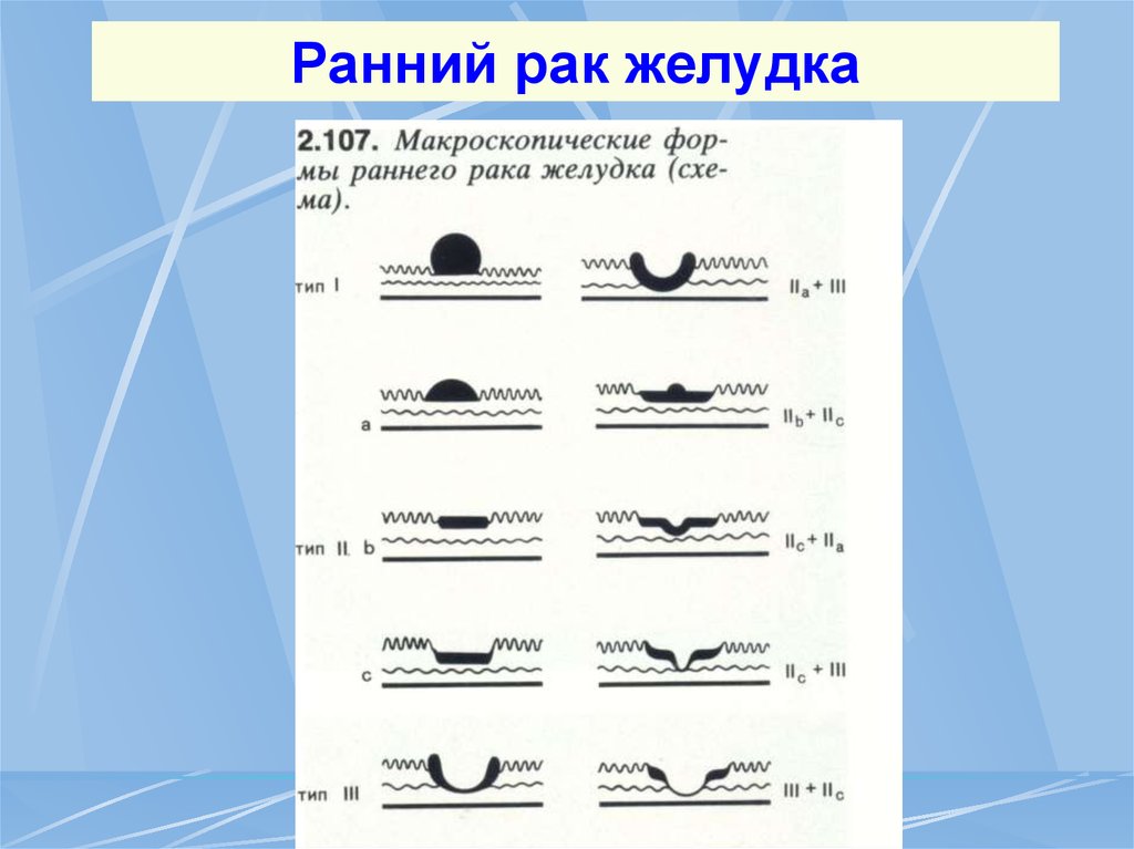 Ранний тип. Желудок Парижская классификация. Парижская классификация опухолей желудка. Классификация полипов по Ямада.