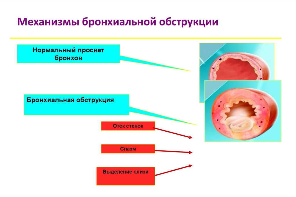 Бронхиальная обструкция. Механизм развития бронхиальной обструкции. Механизмы бронхиальной обструкции при бронхиальной астме. Бронхообструктивный синдром механизмы механизм. Синдром бронхиальной обструкции механизм.