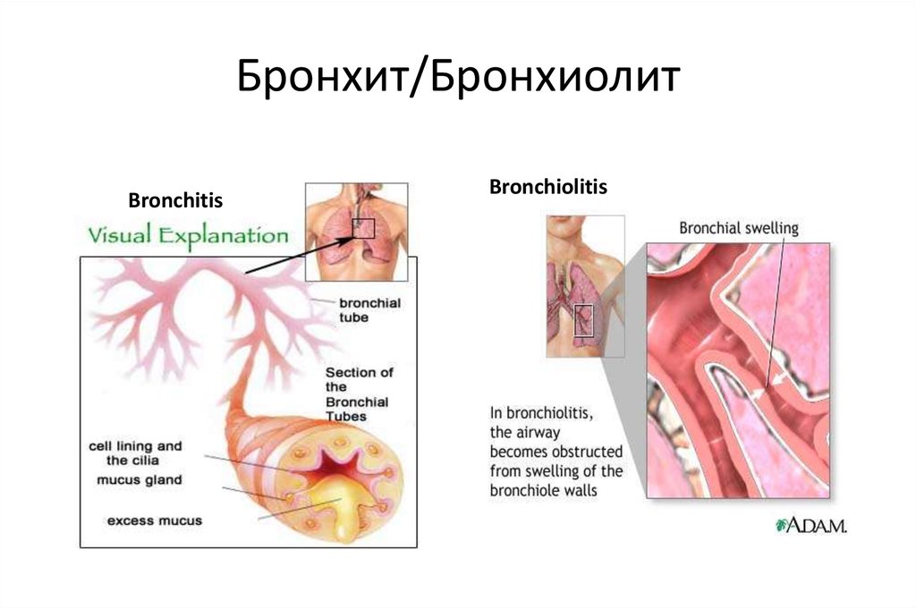 Бронхит педиатрия презентация