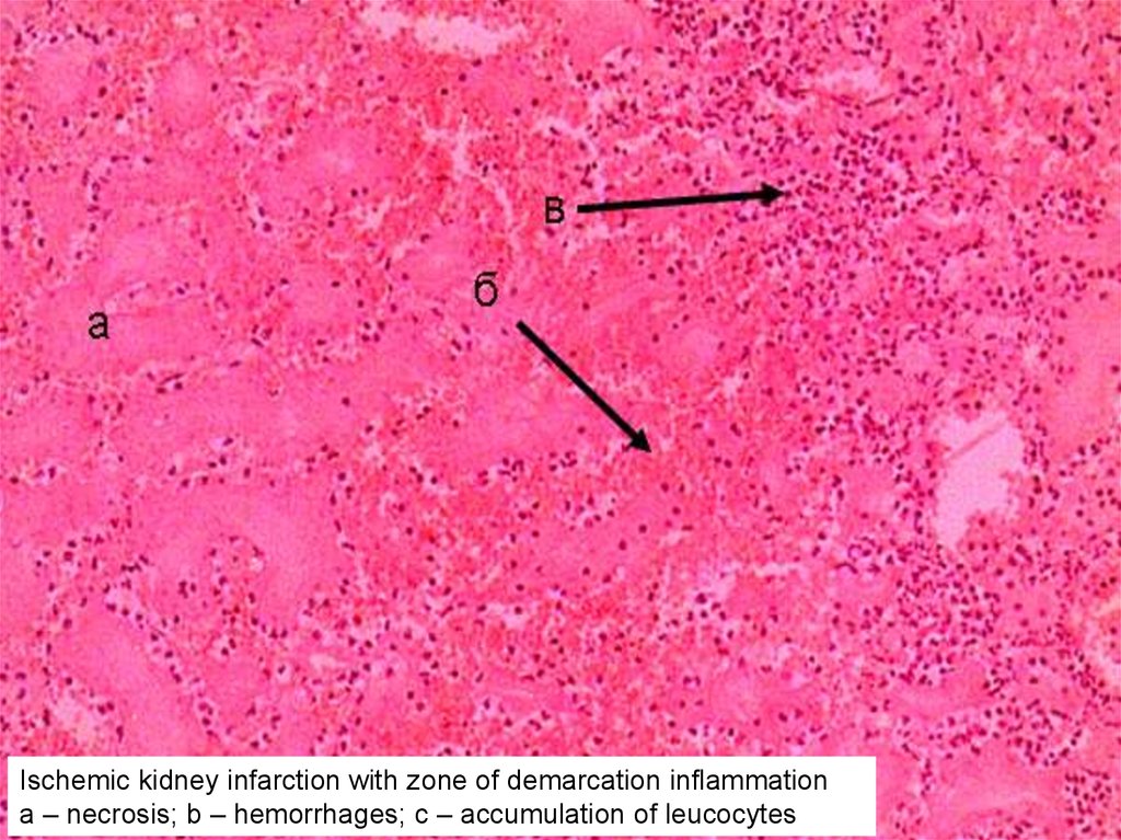 Ишемический инфаркт. Ишемический инфаркт почки макропрепарат. Инфаркт почки с зоной демаркационного воспаления. Ишемический инфаркт в плаценте микропрепарат. Ишемический инфаркт почки микропрепарат.