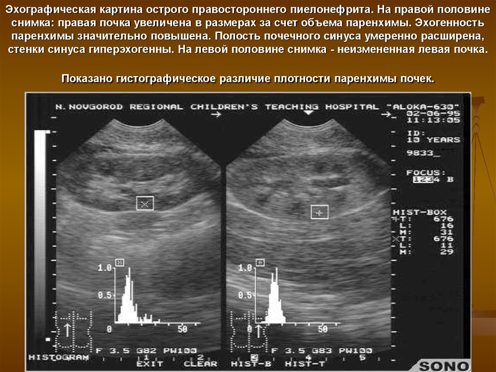 Признаки диффузных изменений обеих почек