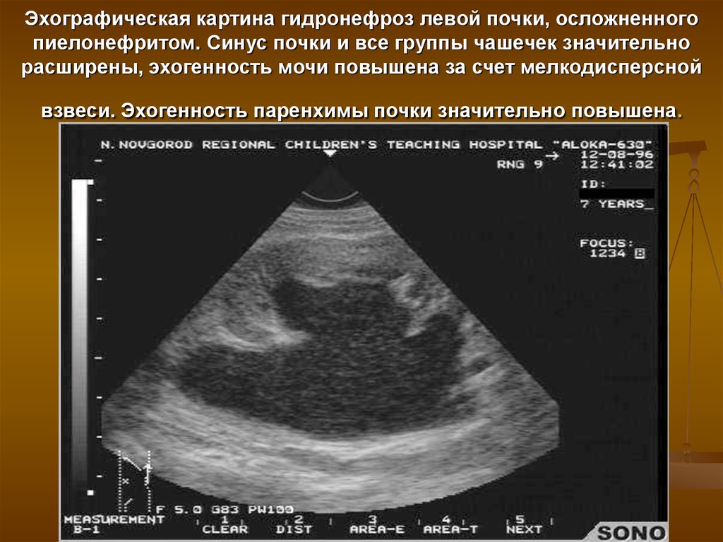 Эхографическая картина нестабильности в сегменте с2 с3