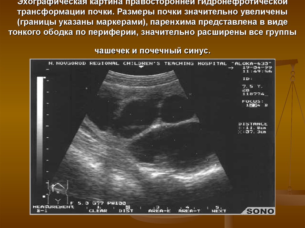 Эхографическая картина. Гидронефрозная трансформация почки. Гидронефротической трансформации почки на УЗИ. Гидронефротическая трансформация почек на УЗИ степени. Гидронефроз почки по УЗИ.