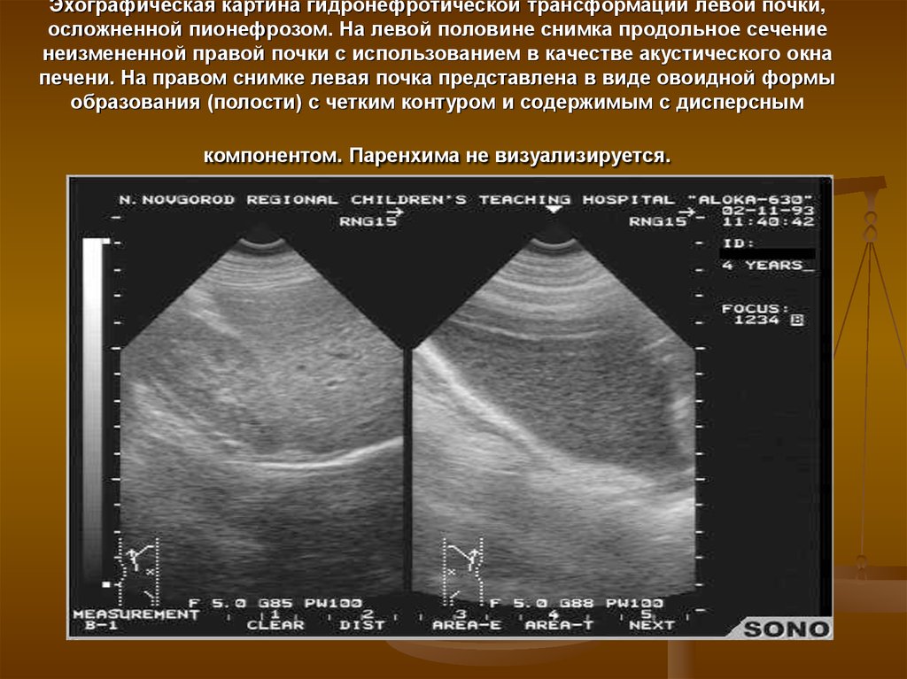 Эхографическая картина почек