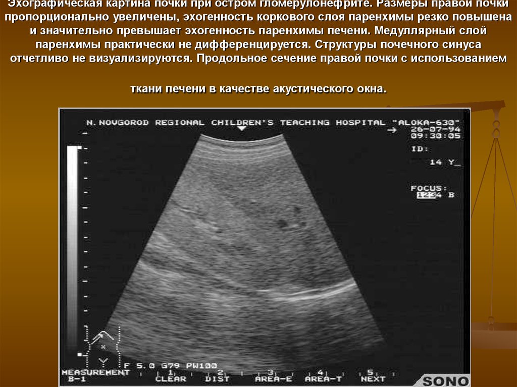 Диффузная паренхима почек. Хронический гломерулонефрит УЗИ почек. Острый гломерулонефрит УЗИ почек. Хронический гломерулонефрит УЗИ. Гломерулонефрит на УЗИ почек.