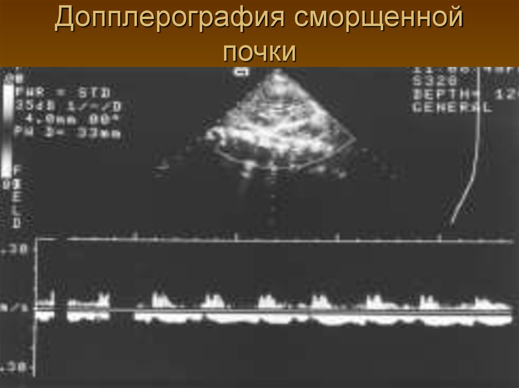 Узи почек с доплером. Допплерография почек. УЗИ картина сморщенной почки. Сморщенная почка УЗИ протокол.