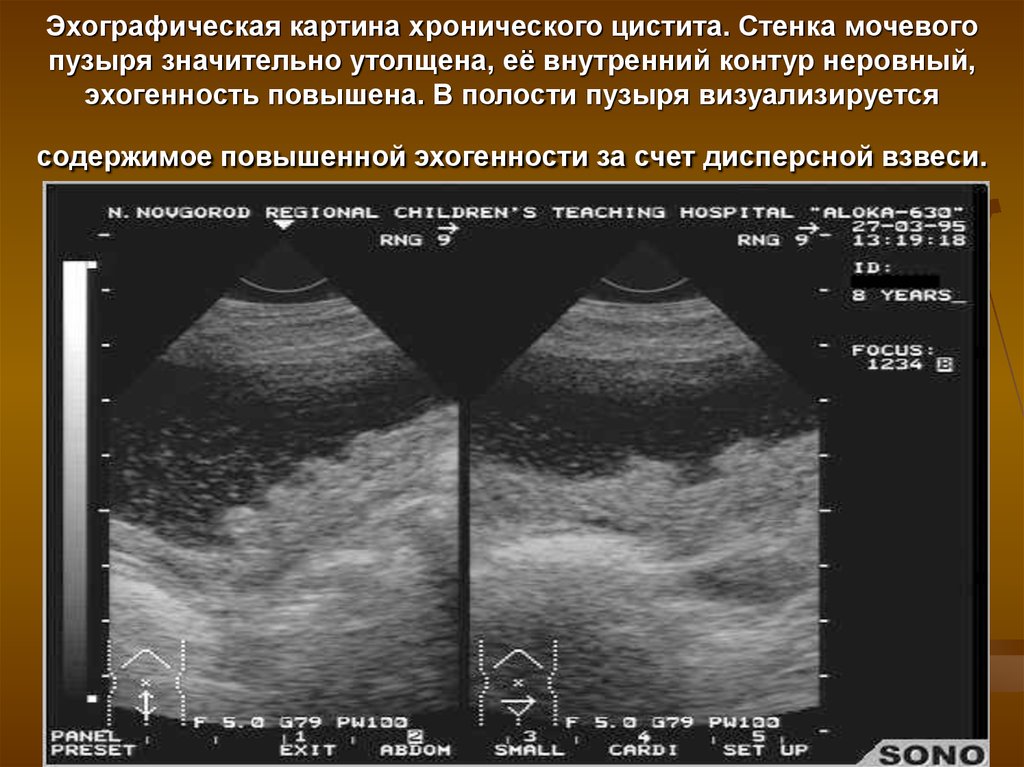 Осадок в мочевом пузыре