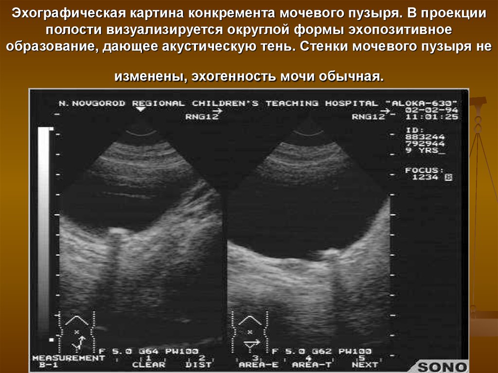 Эхографическая картина почек