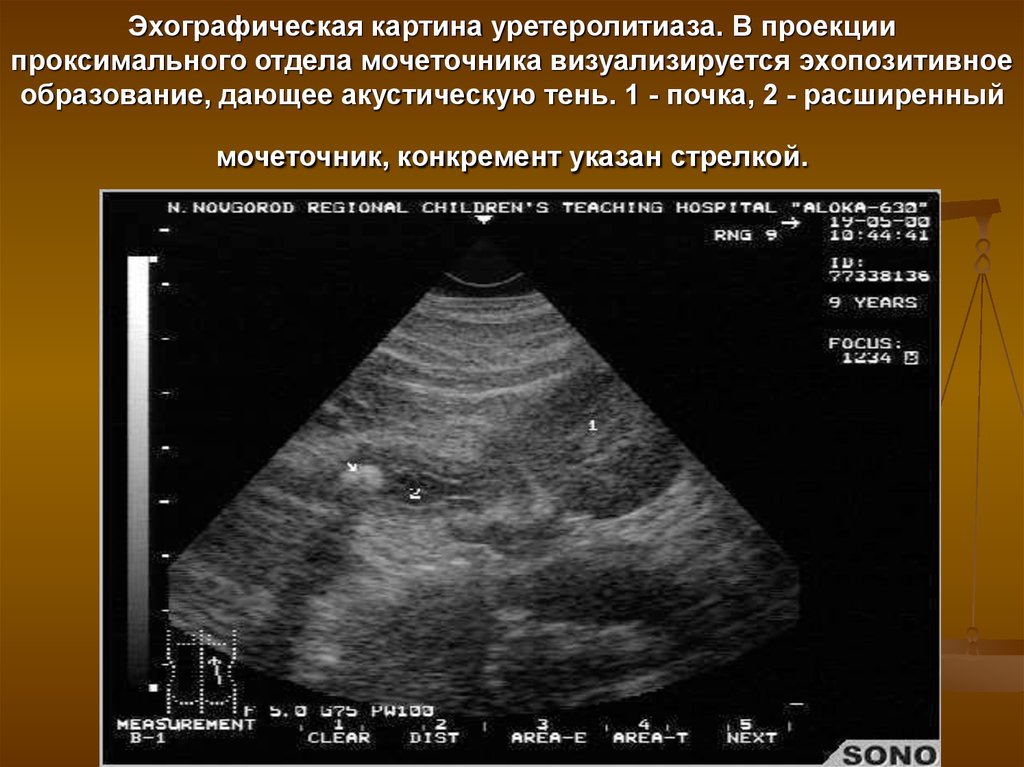 Эхографическая картина нестабильности в сегменте с2 с3