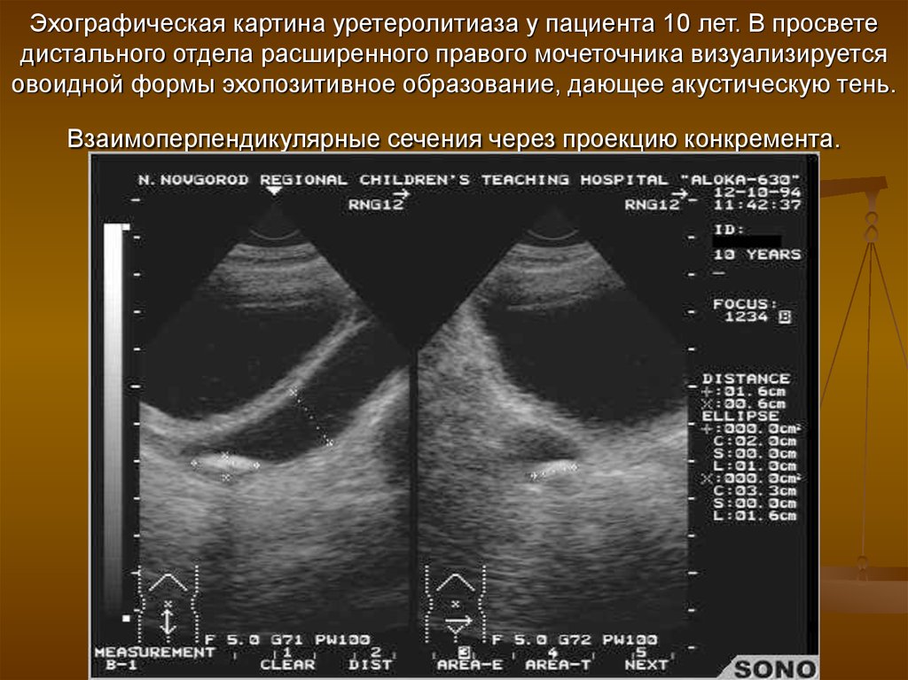 Эхографическое изображение злокачественной опухоли чаще представляет собой образование